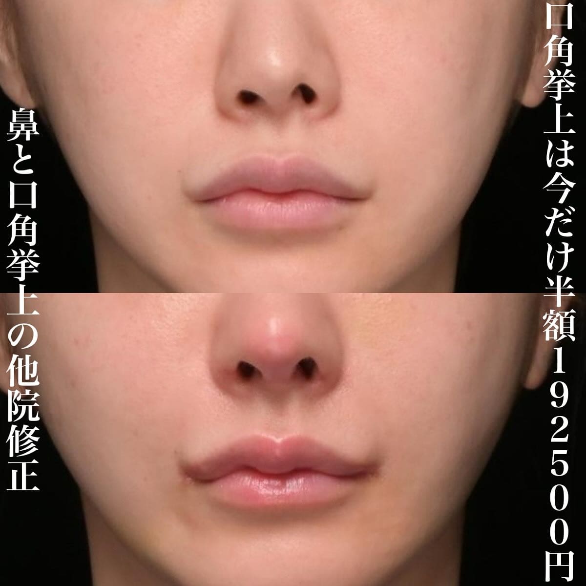鉄医師による鼻整形の術前/術後３ヶ月 หลัง 