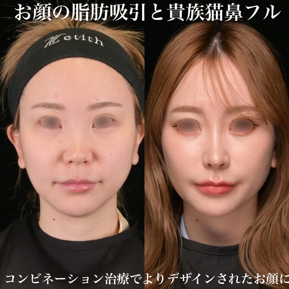 鉄医師による鼻整形の術前/術後6ヶ月
