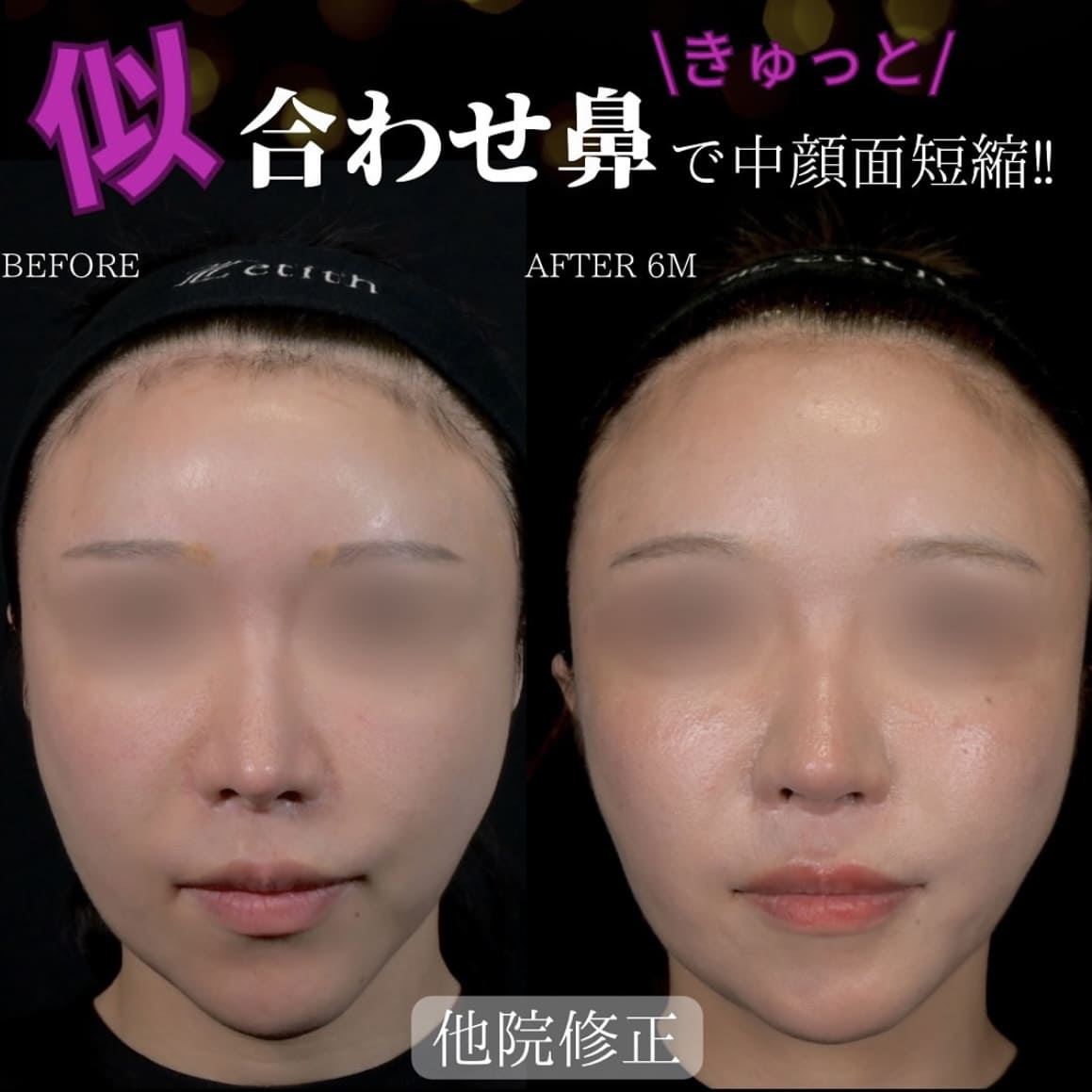 守屋医師による鼻整形の術前/術後6ヶ月