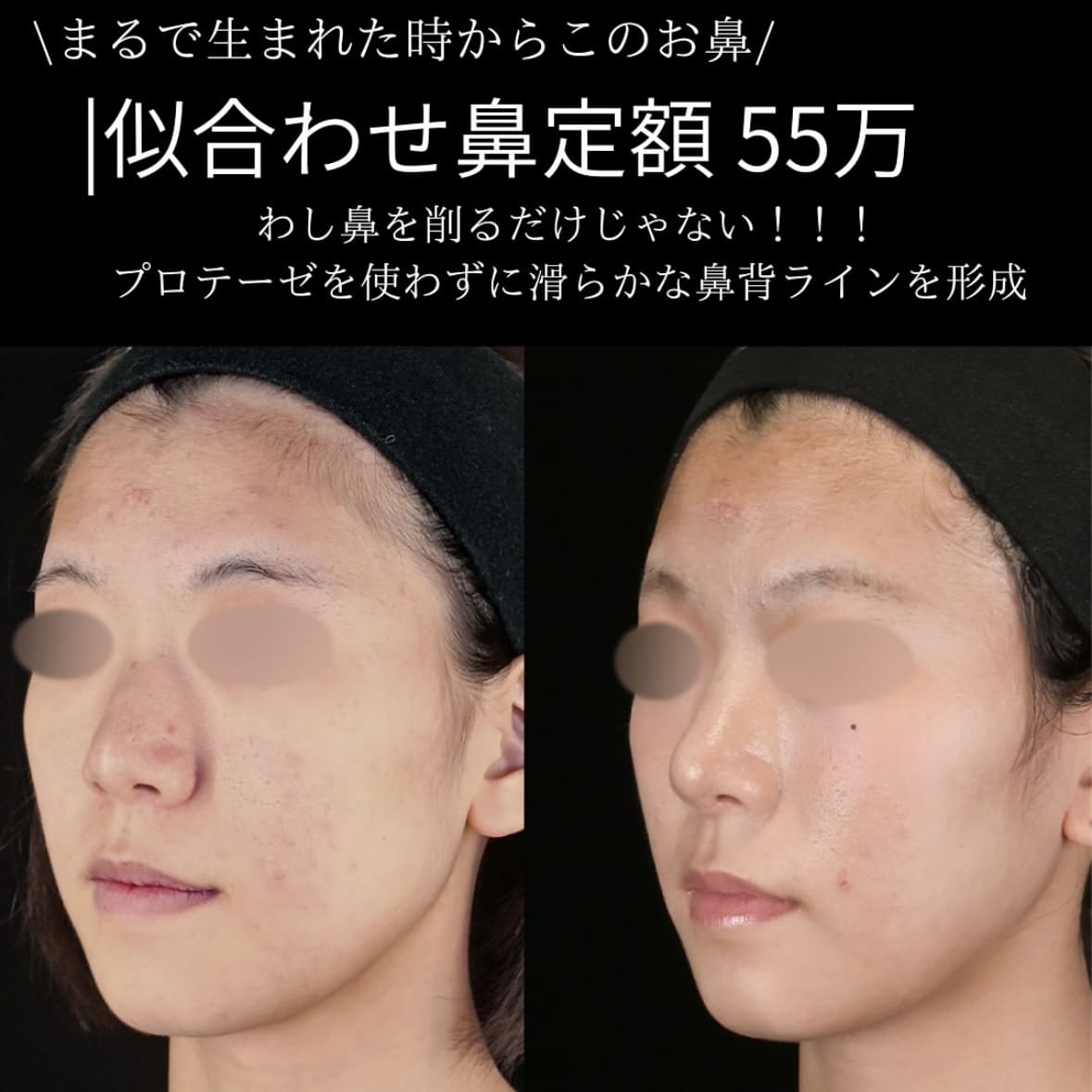 守屋医師による鼻整形の術前/術後