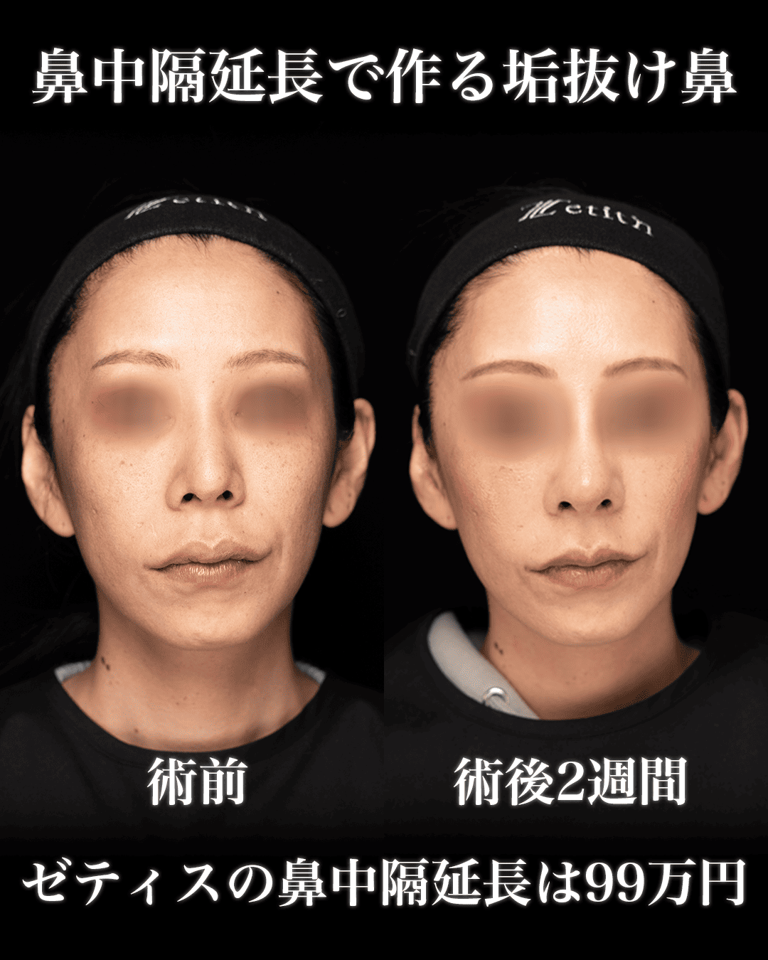 中村医師による鼻整形の術前/術後2週間
