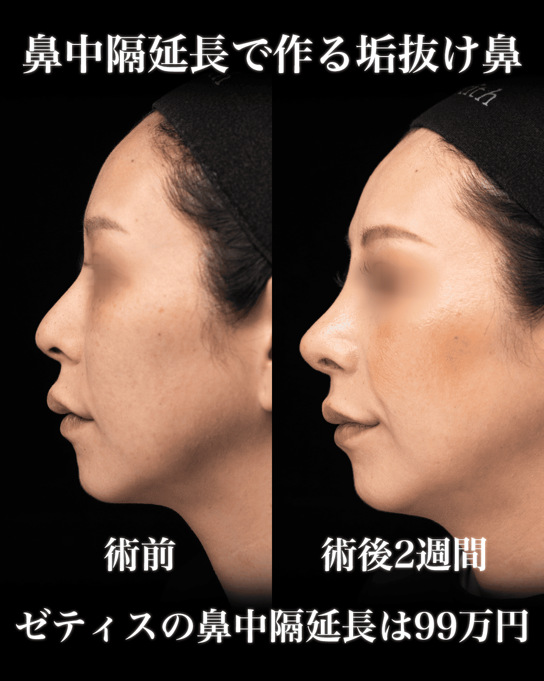 中村医師による鼻整形の術前/術後2週間 Дараа 