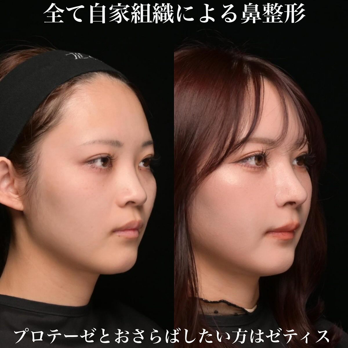 鉄医師による鼻整形の術前/術後2週間 After 