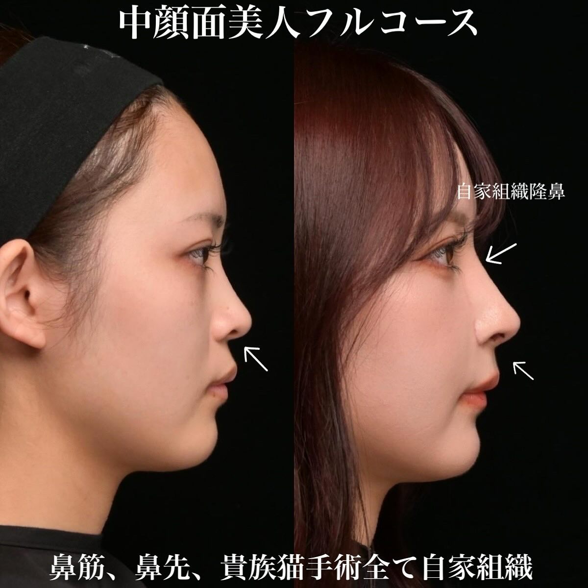 鉄医師による鼻整形の術前/術後2週間