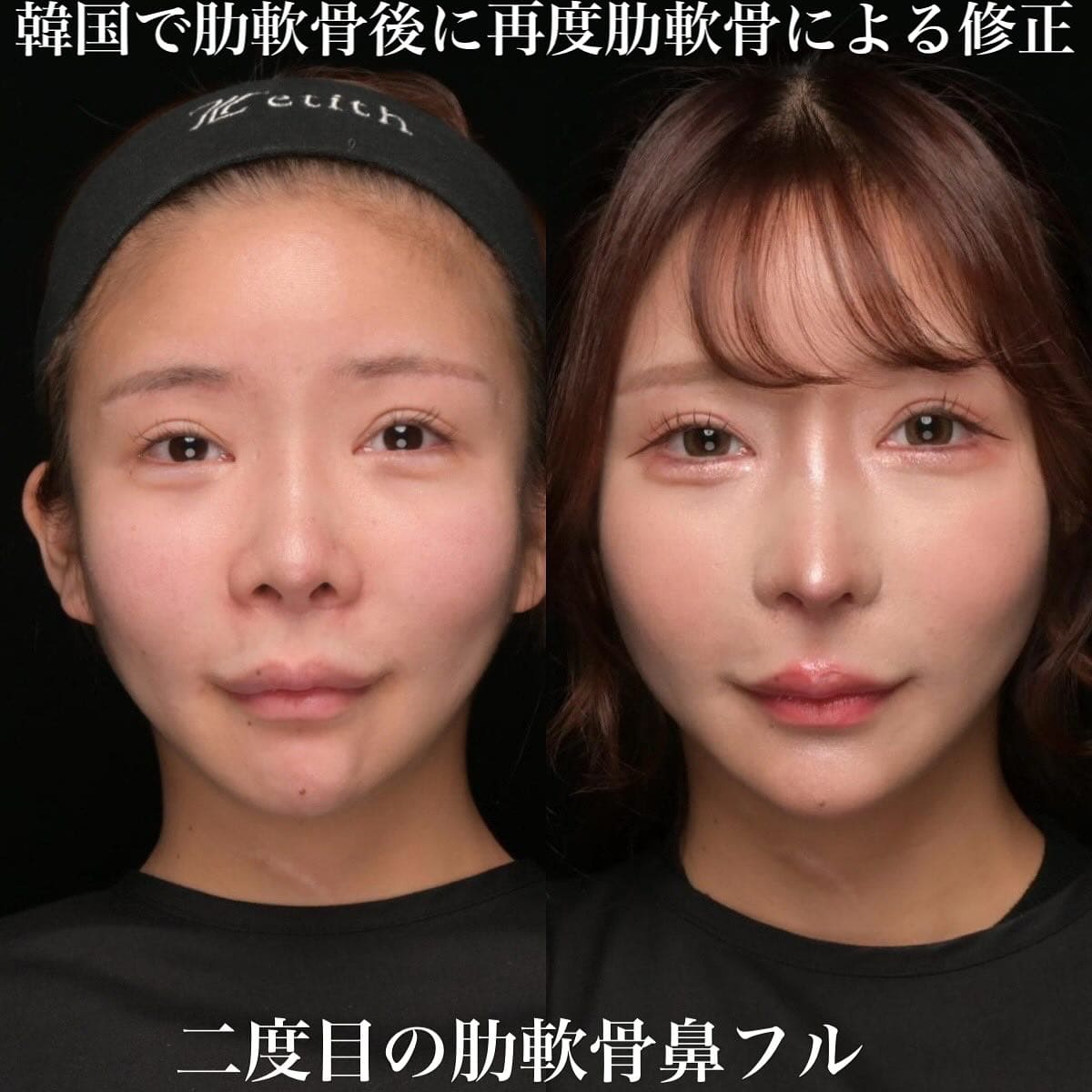 鉄医師による鼻整形の術前/術後ヶ月