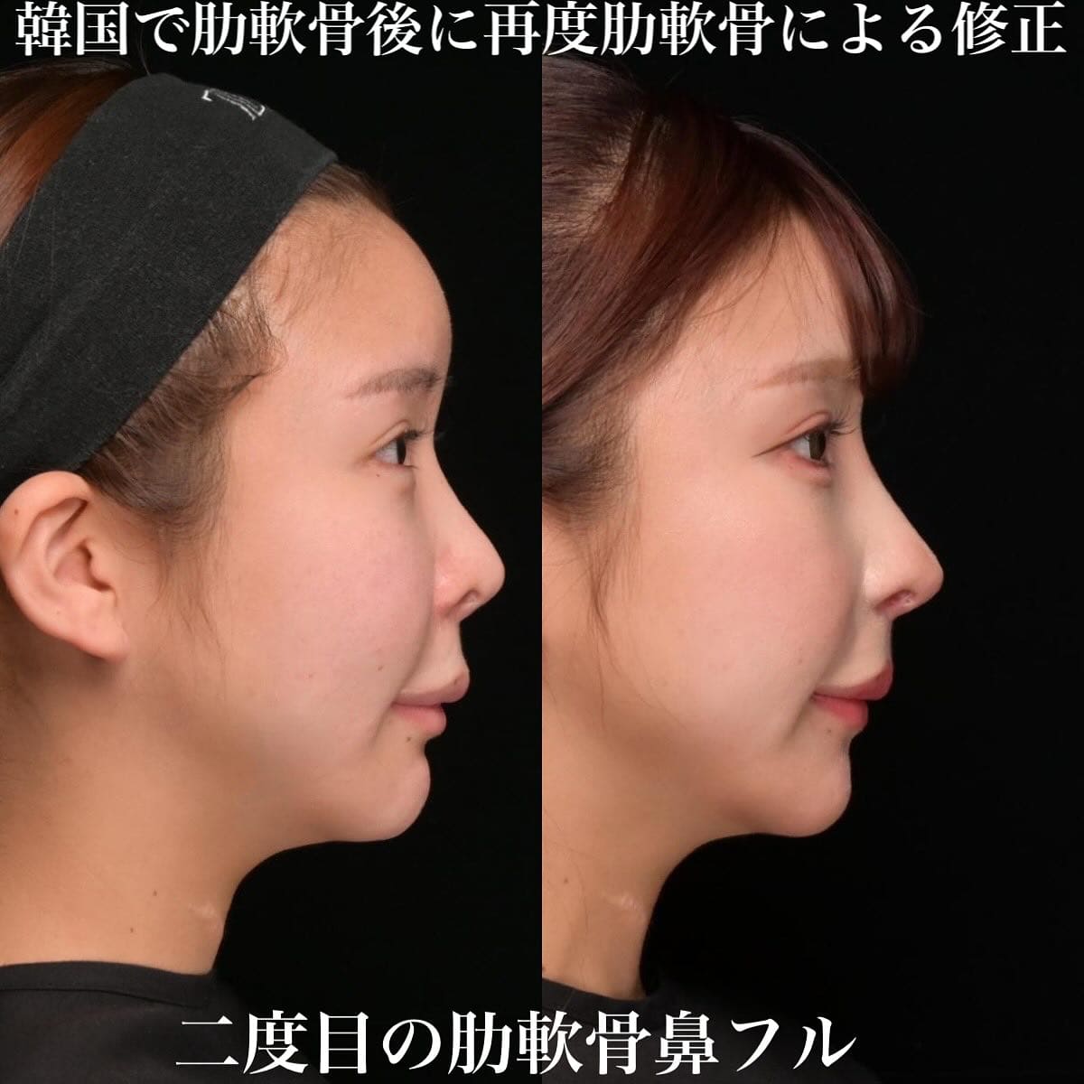 鉄医師による鼻整形の術前/術後ヶ月 施術後 
