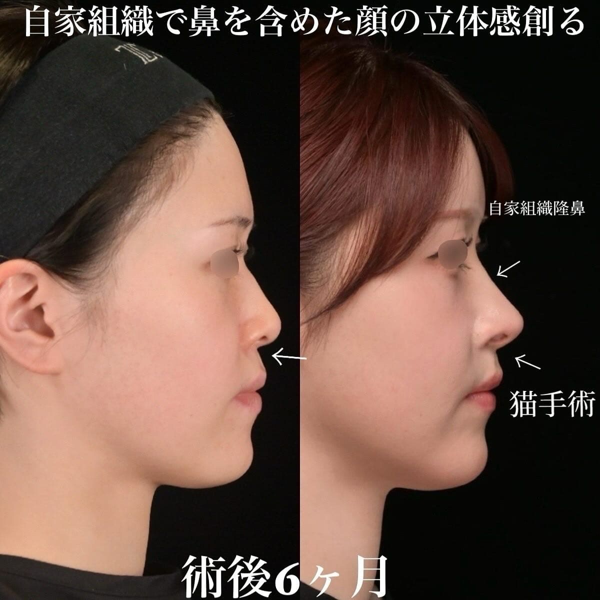 鉄医師による鼻整形の術前/術後6ヶ月 Дараа 