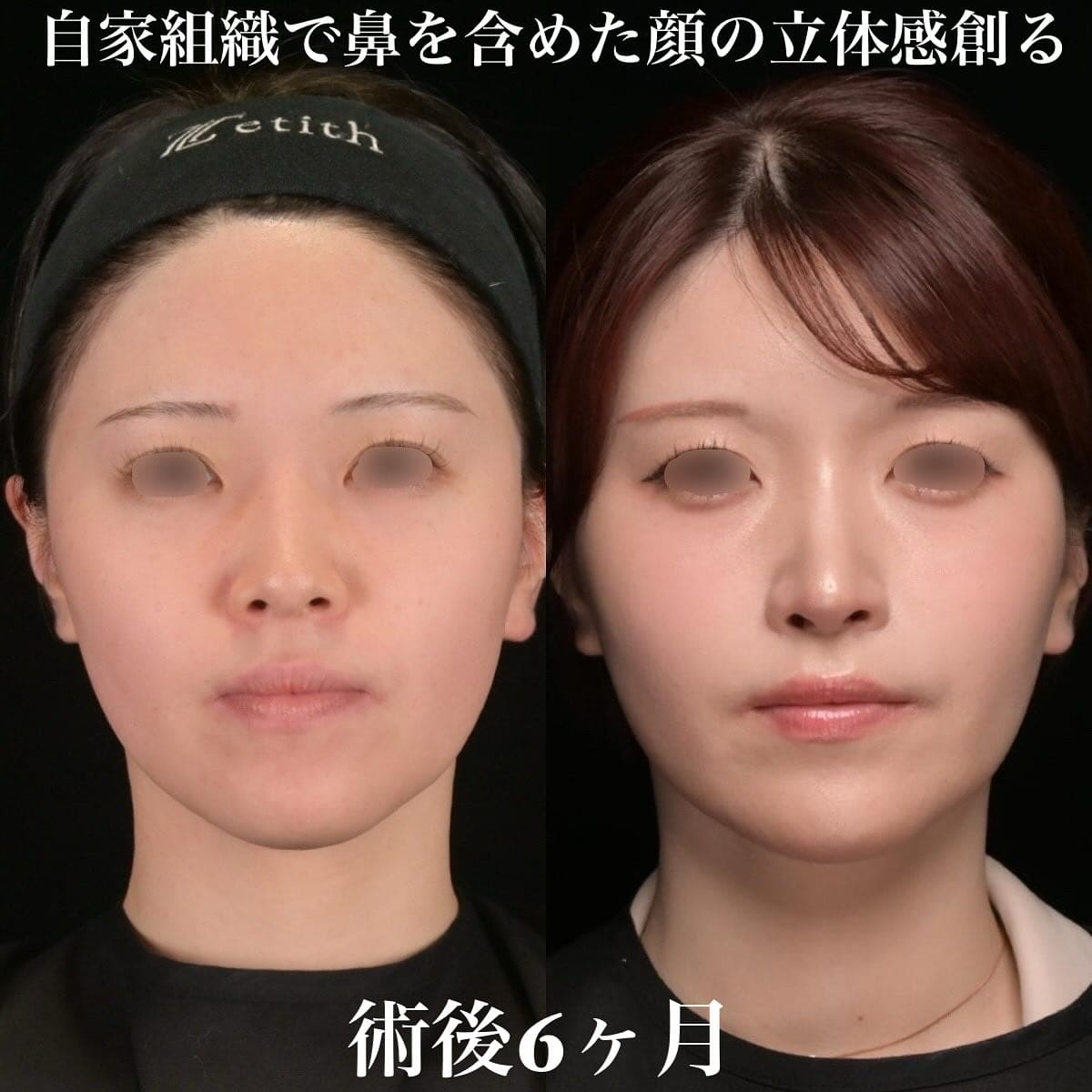 鉄医師による鼻整形の術前/術後6ヶ月