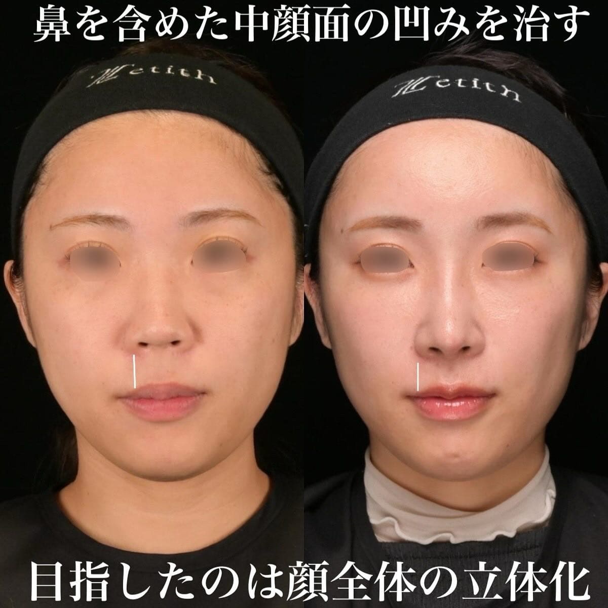 鉄医師による鼻整形の術前/術後３ヶ月
