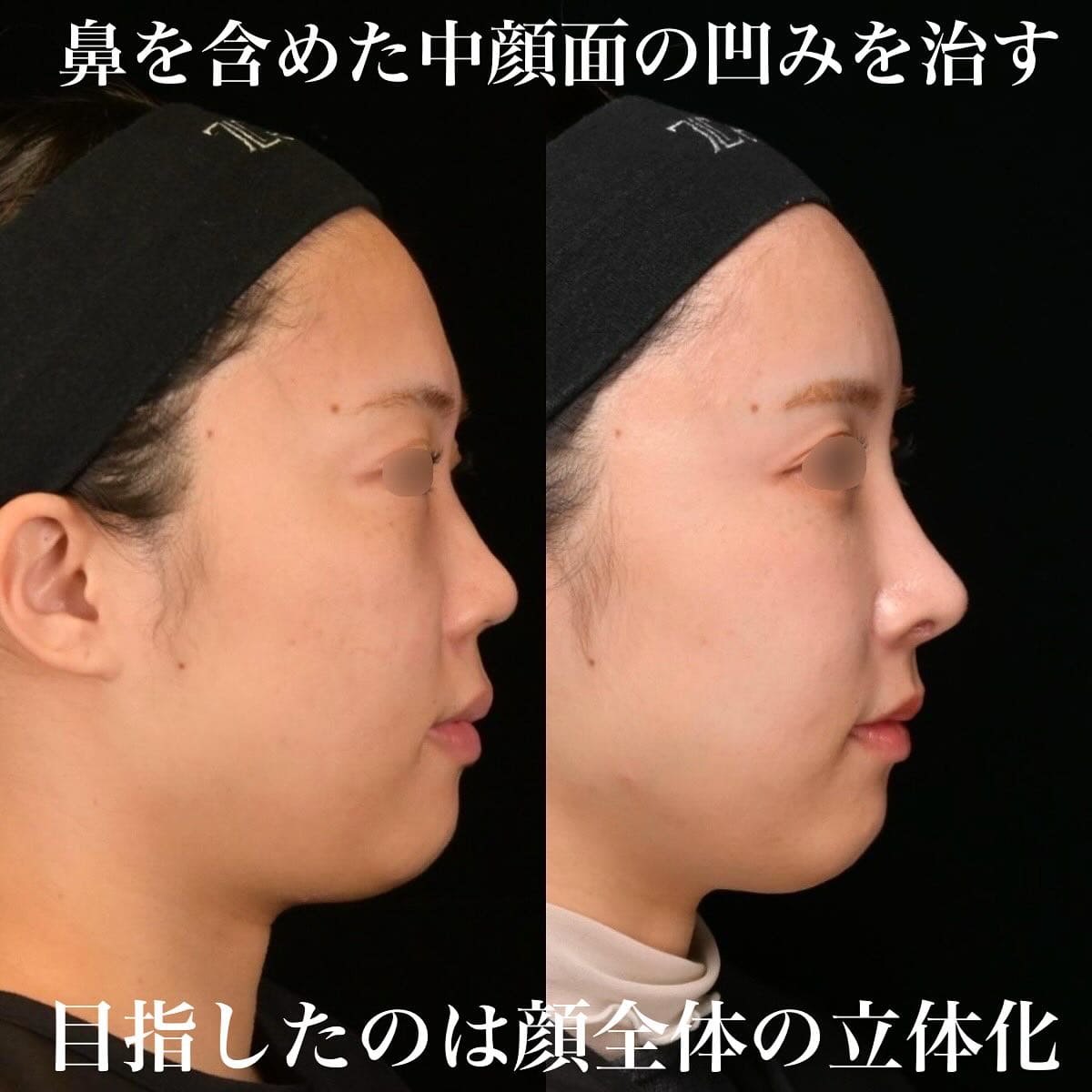 鉄医師による鼻整形の術前/術後３ヶ月 Дараа 