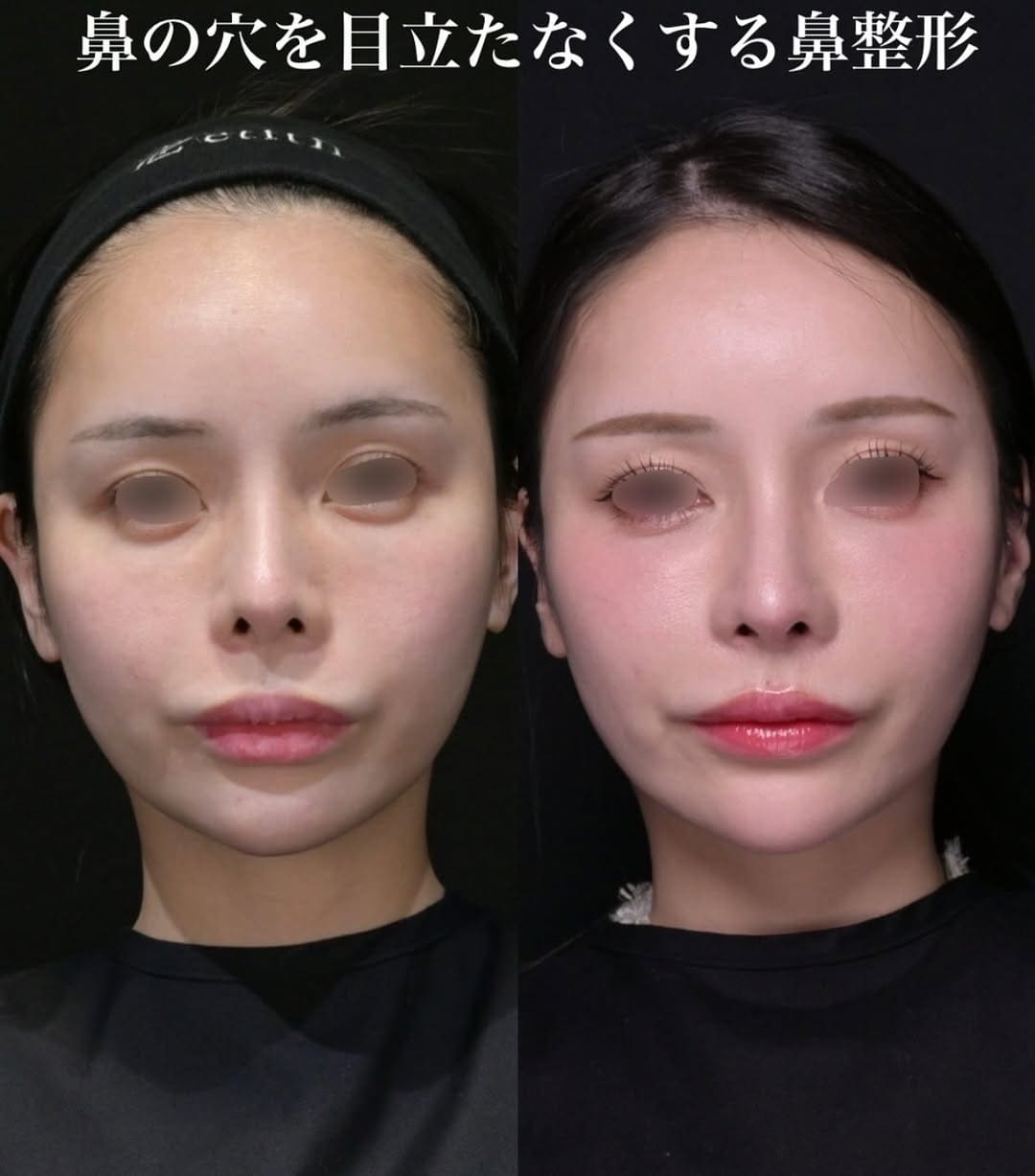 鉄医師による鼻整形の術前/術後３ヶ月