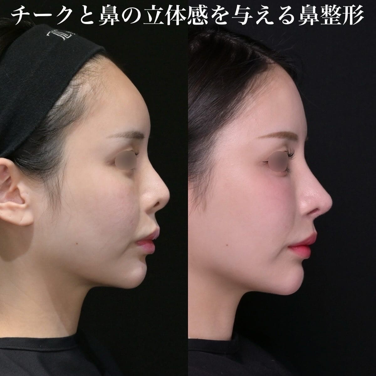 鉄医師による鼻整形の術前/術後３ヶ月 施術後 