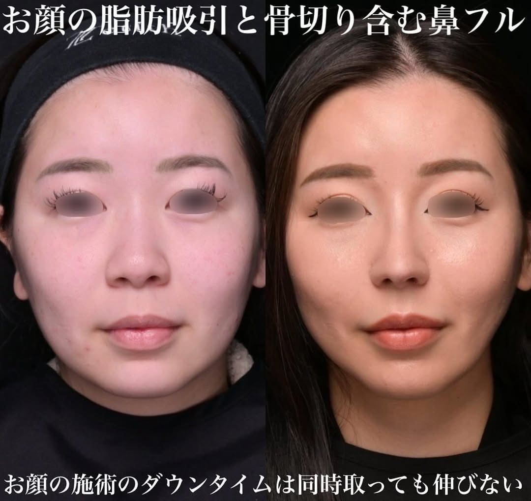 鉄医師による鼻整形の術前/術後1ヶ月