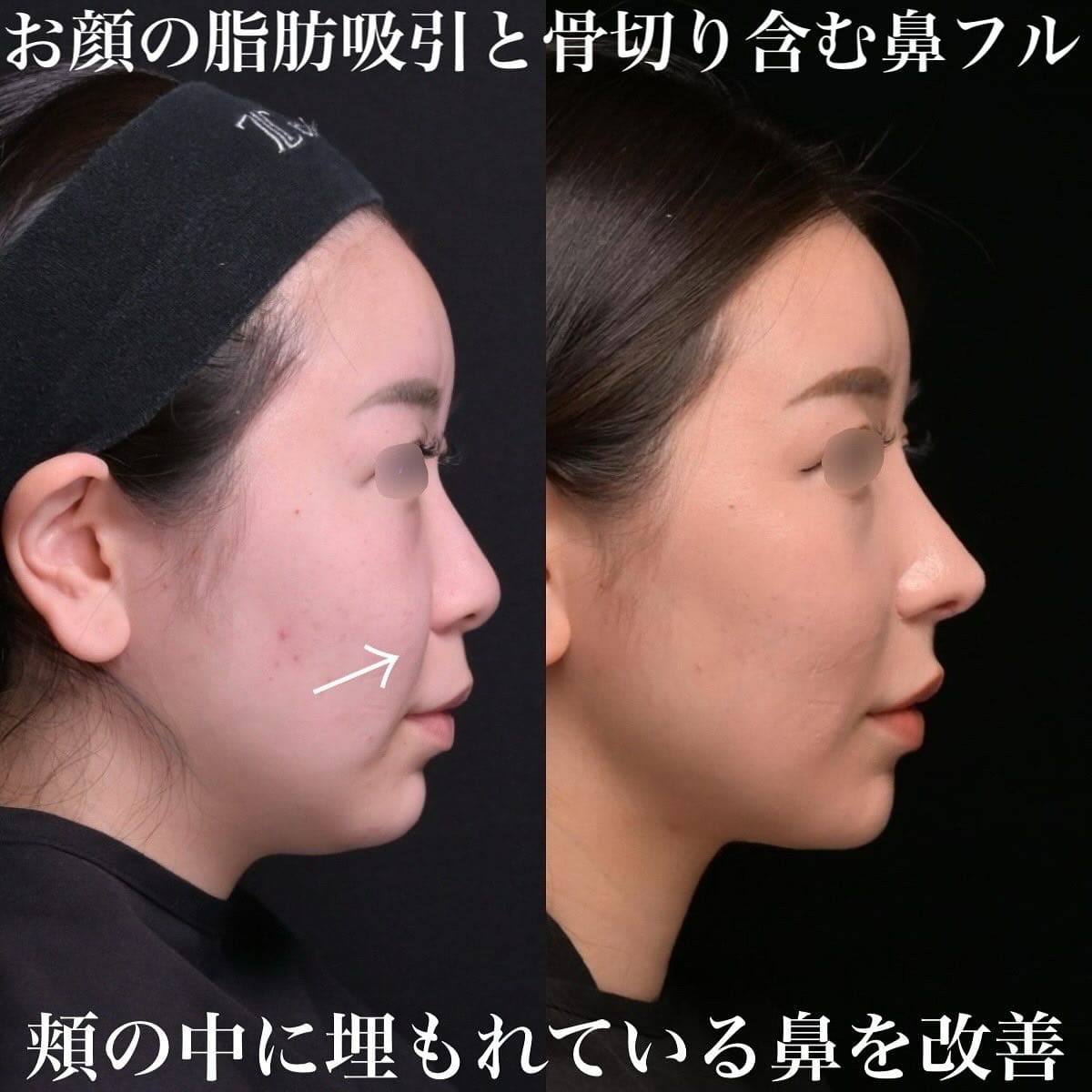 鉄医師による鼻整形の術前/術後1ヶ月 术后 