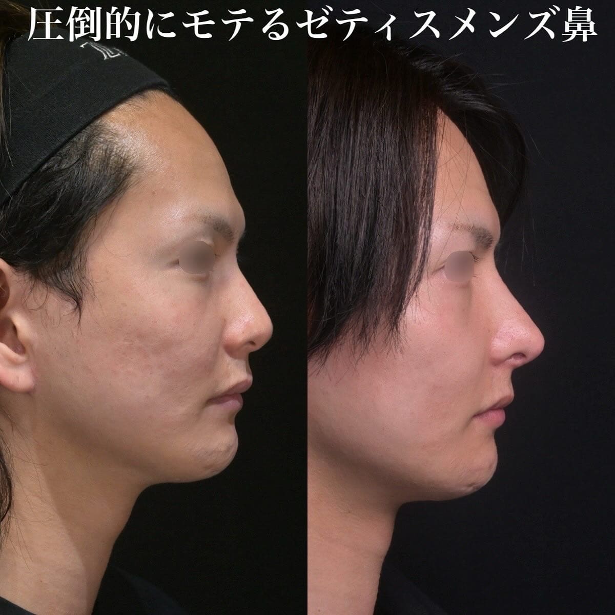 鉄医師による鼻整形の術前/術後6ヶ月 After 
