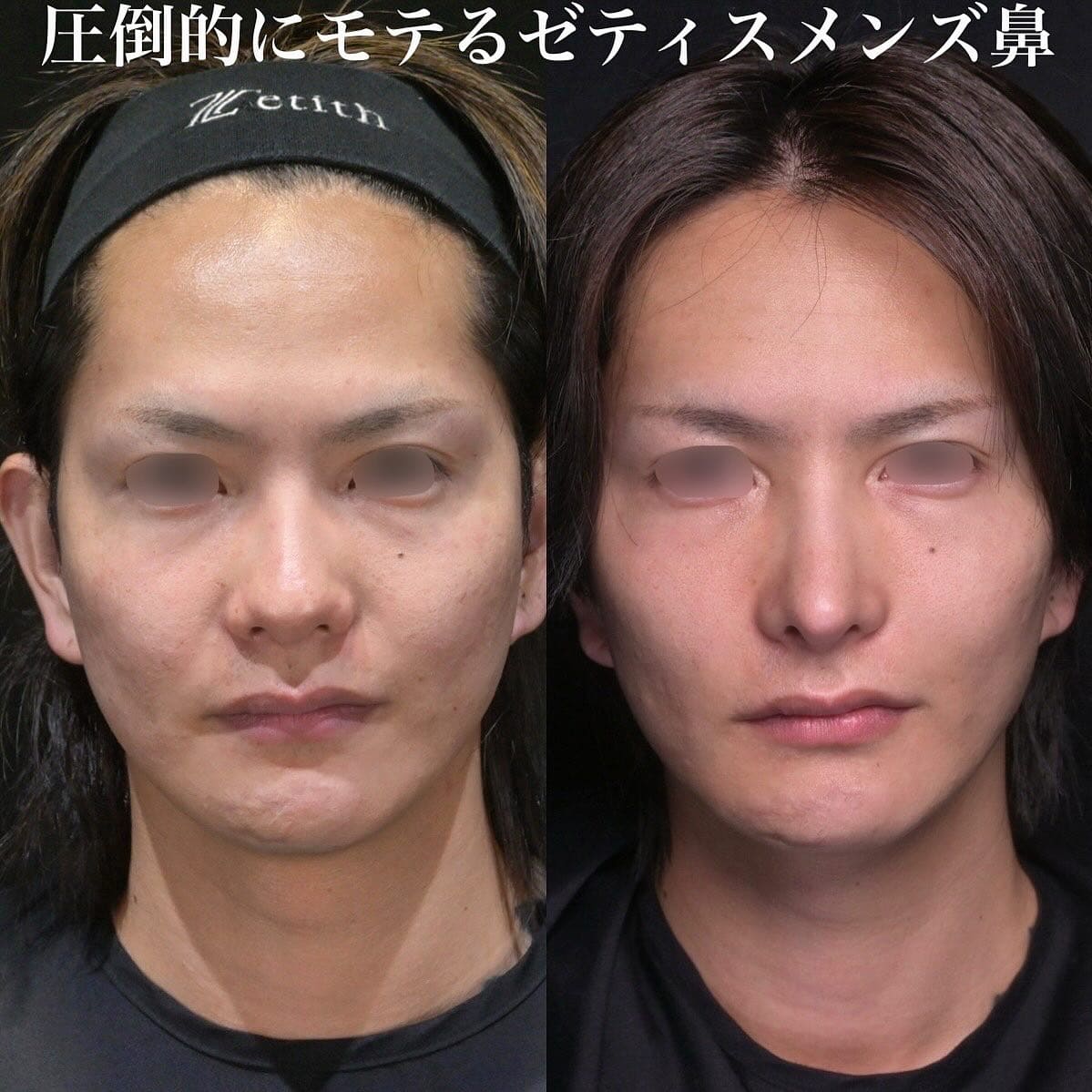 鉄医師による鼻整形の術前/術後6ヶ月