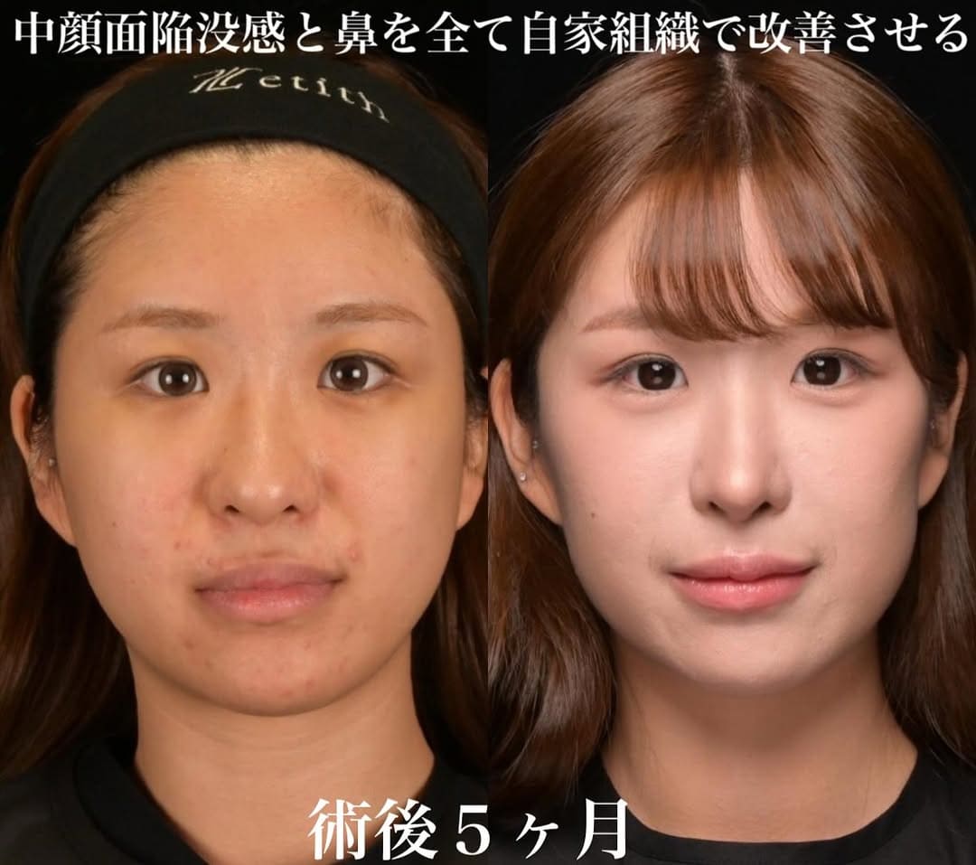 鉄医師による鼻整形の術前/術後5ヶ月
