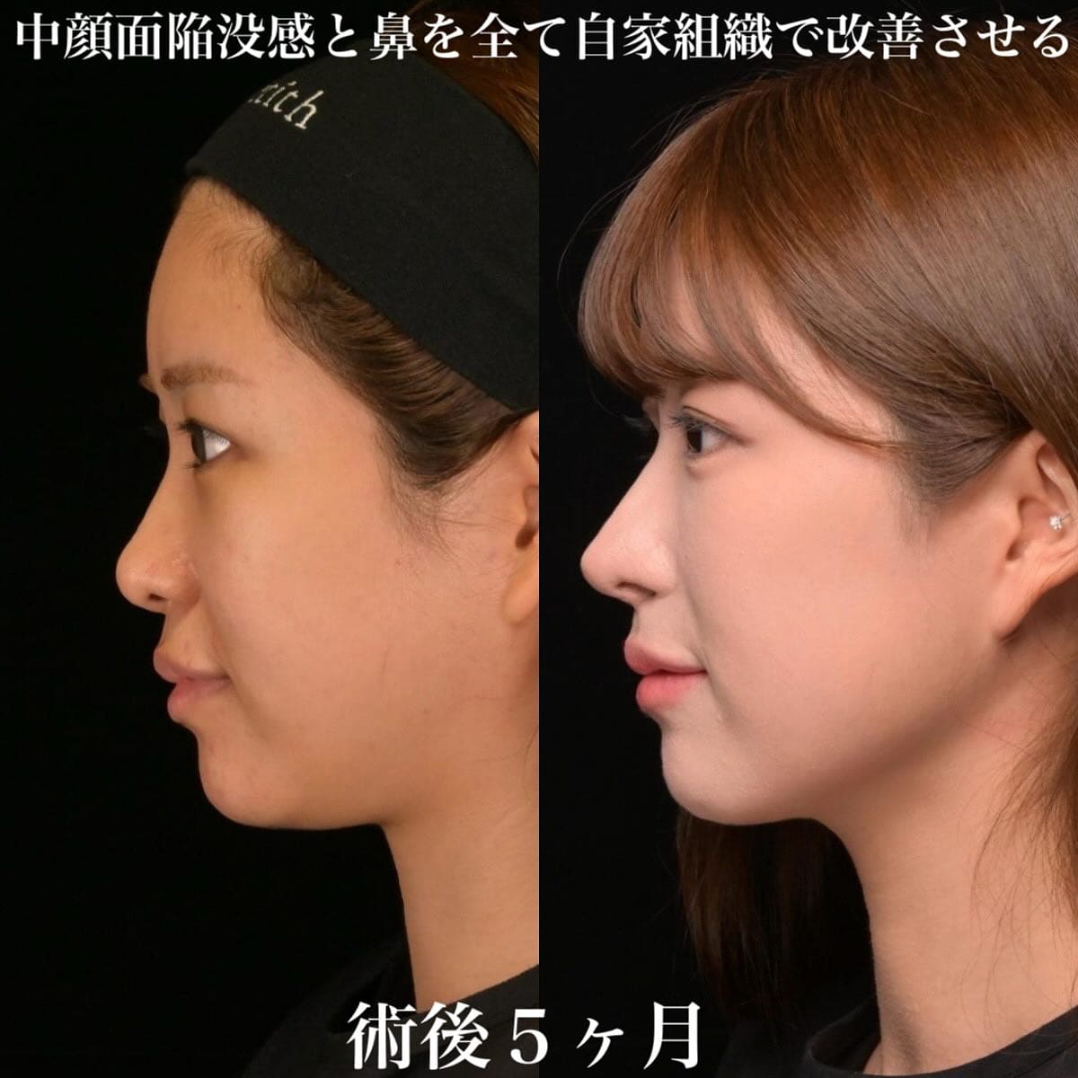 鉄医師による鼻整形の術前/術後5ヶ月 施術後 