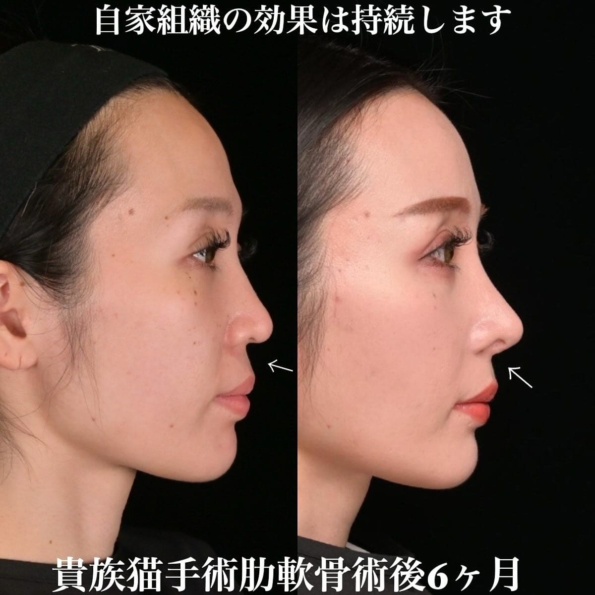 鉄医師による鼻整形の術前/術後6ヶ月 施術後 