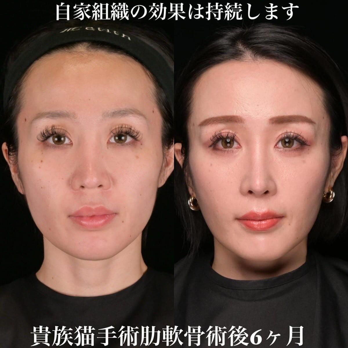 鉄医師による鼻整形の術前/術後6ヶ月