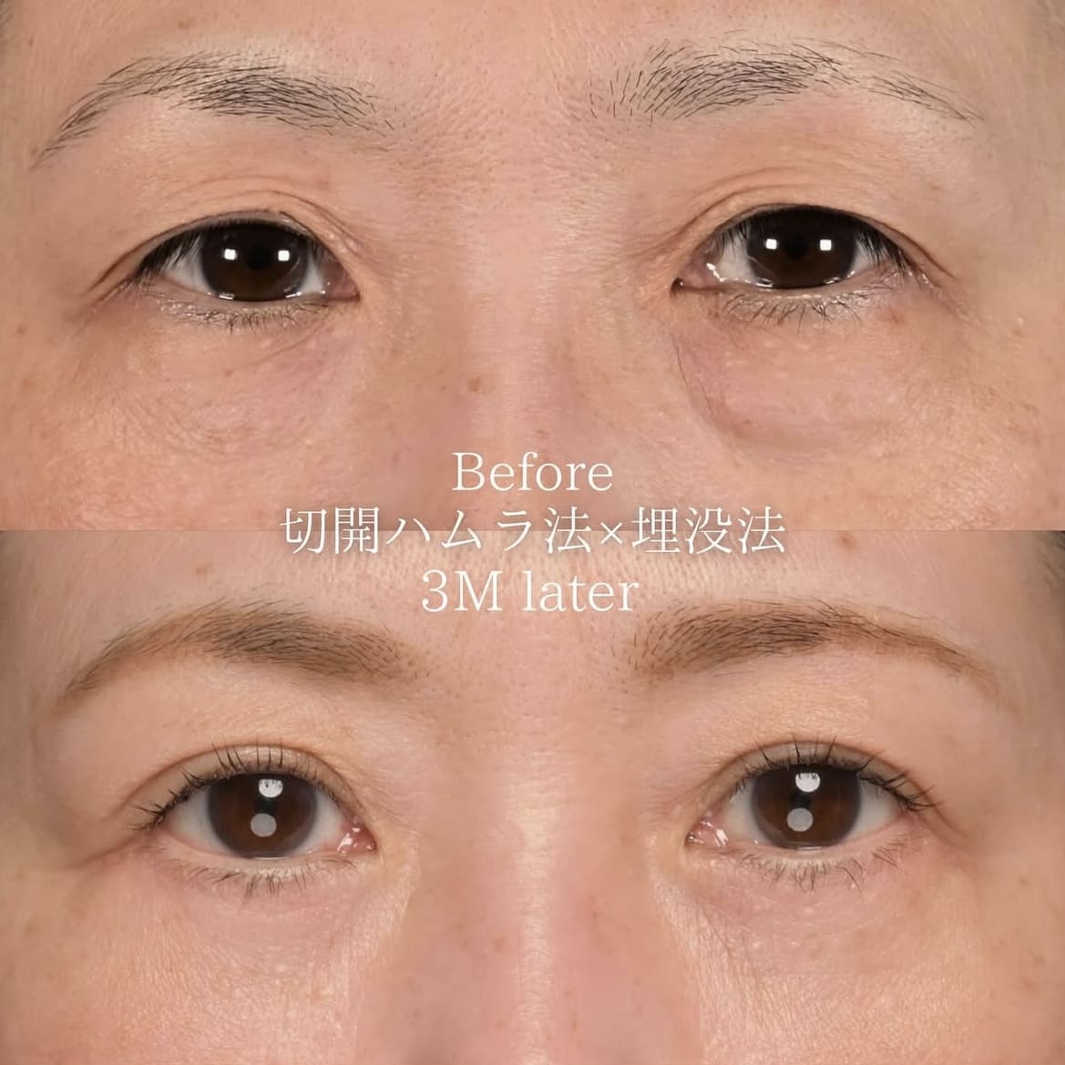 楠本医師による目元整形の術前/術後