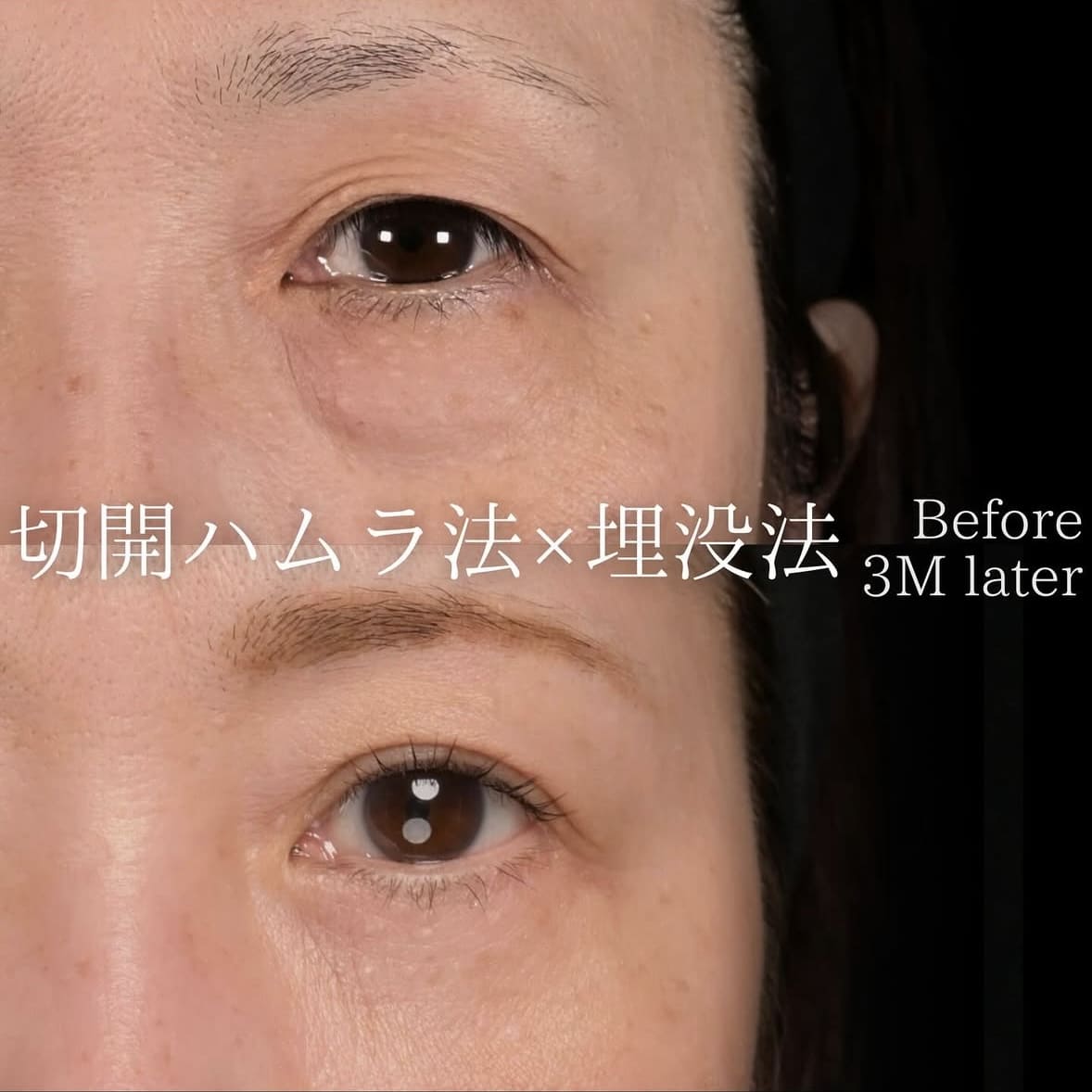 楠本医師による目元整形の術前/術後 Дараа 