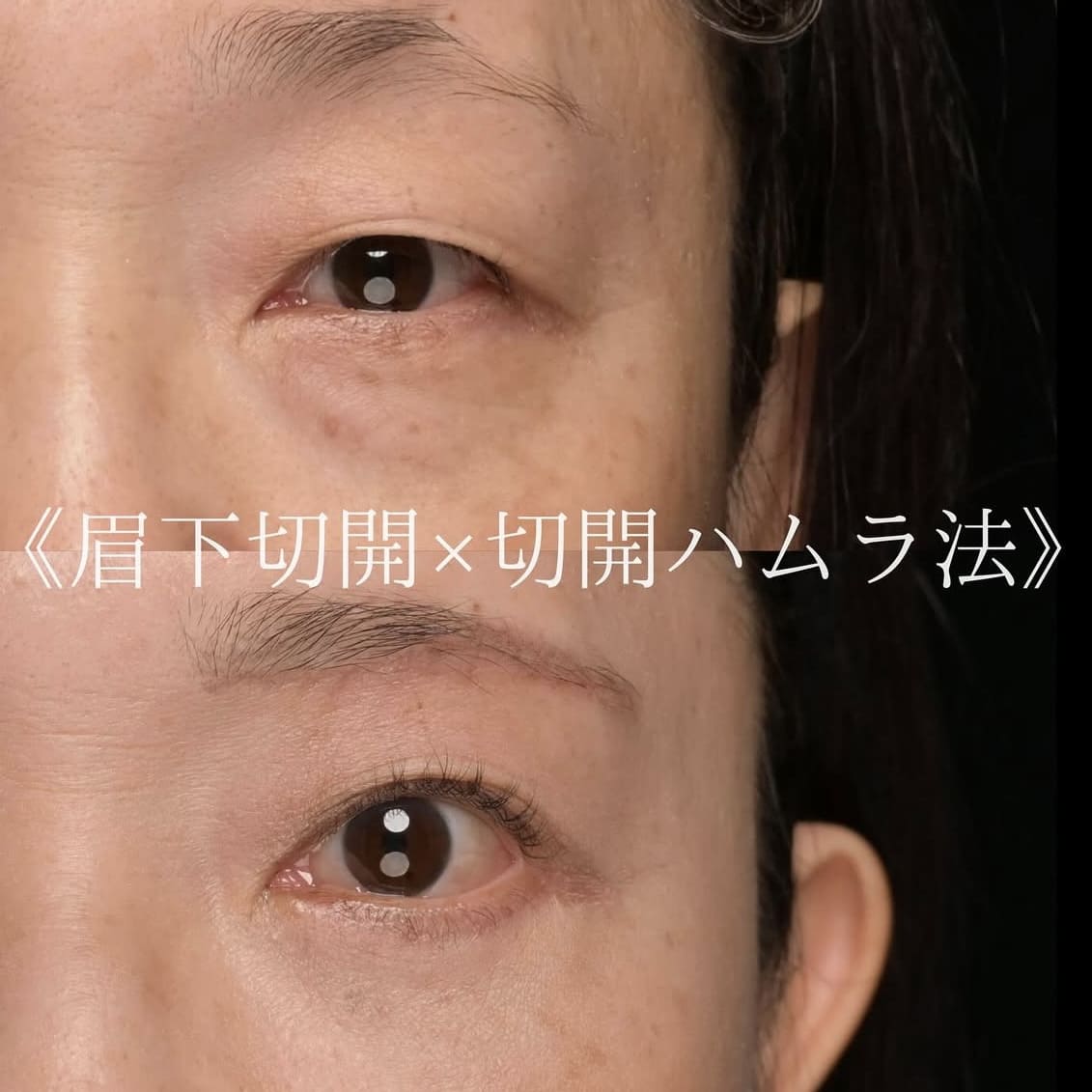 楠本医師による目元整形の術前/術後