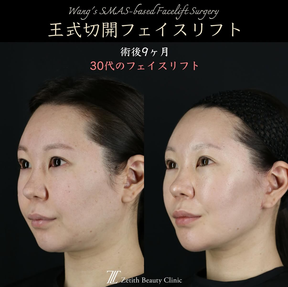 王医師による切開リフトの術前/術後9ヶ月 术后 