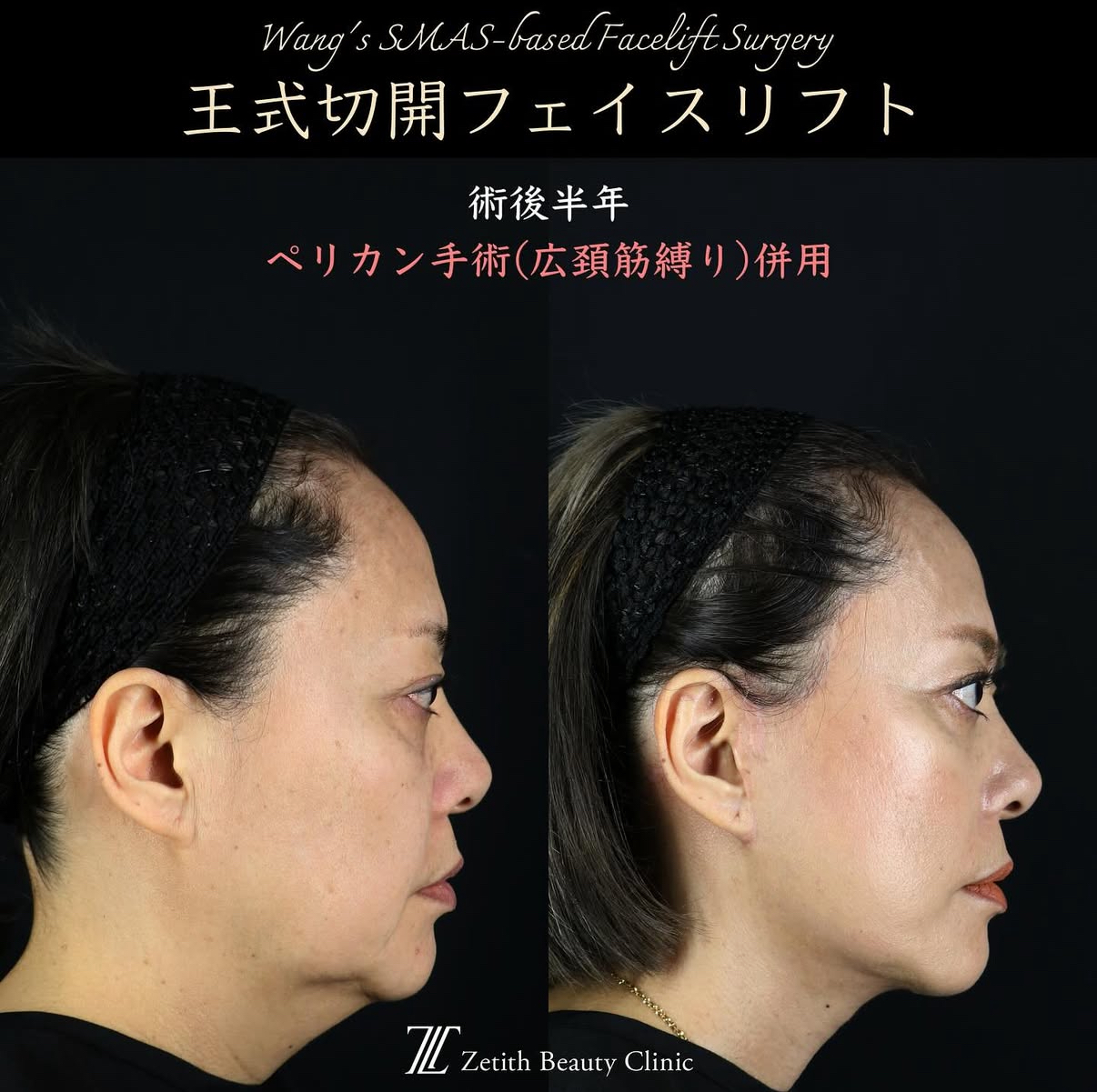 王医師による切開リフトの術前/術後6ヶ月 หลัง 