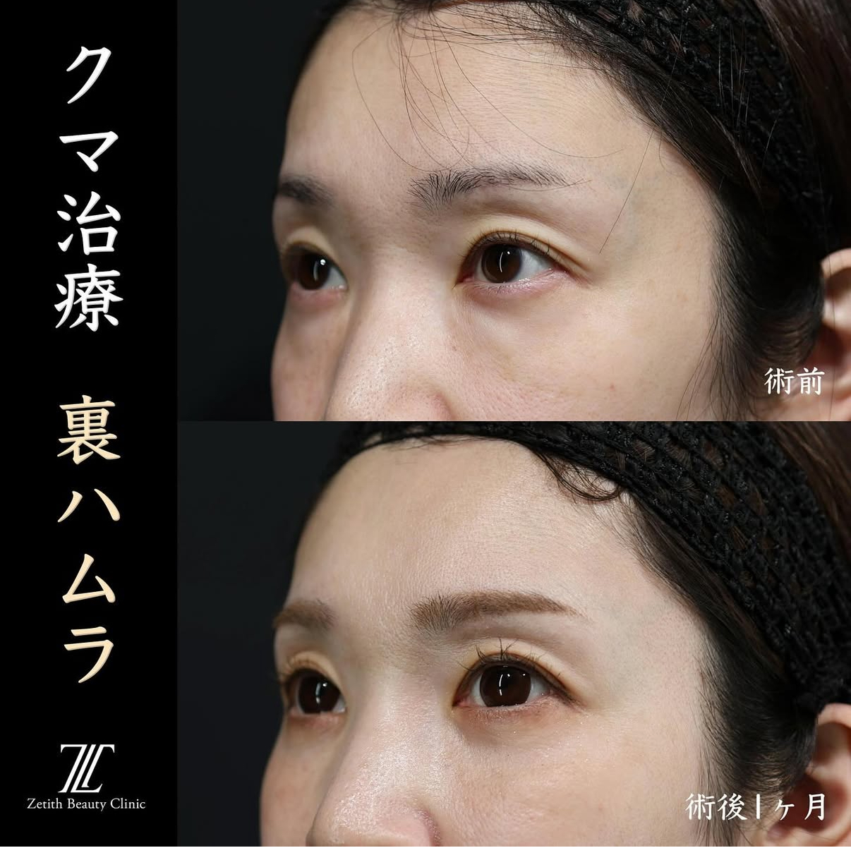 王医師によるクマ治療の術前/術後1ヶ月 After 