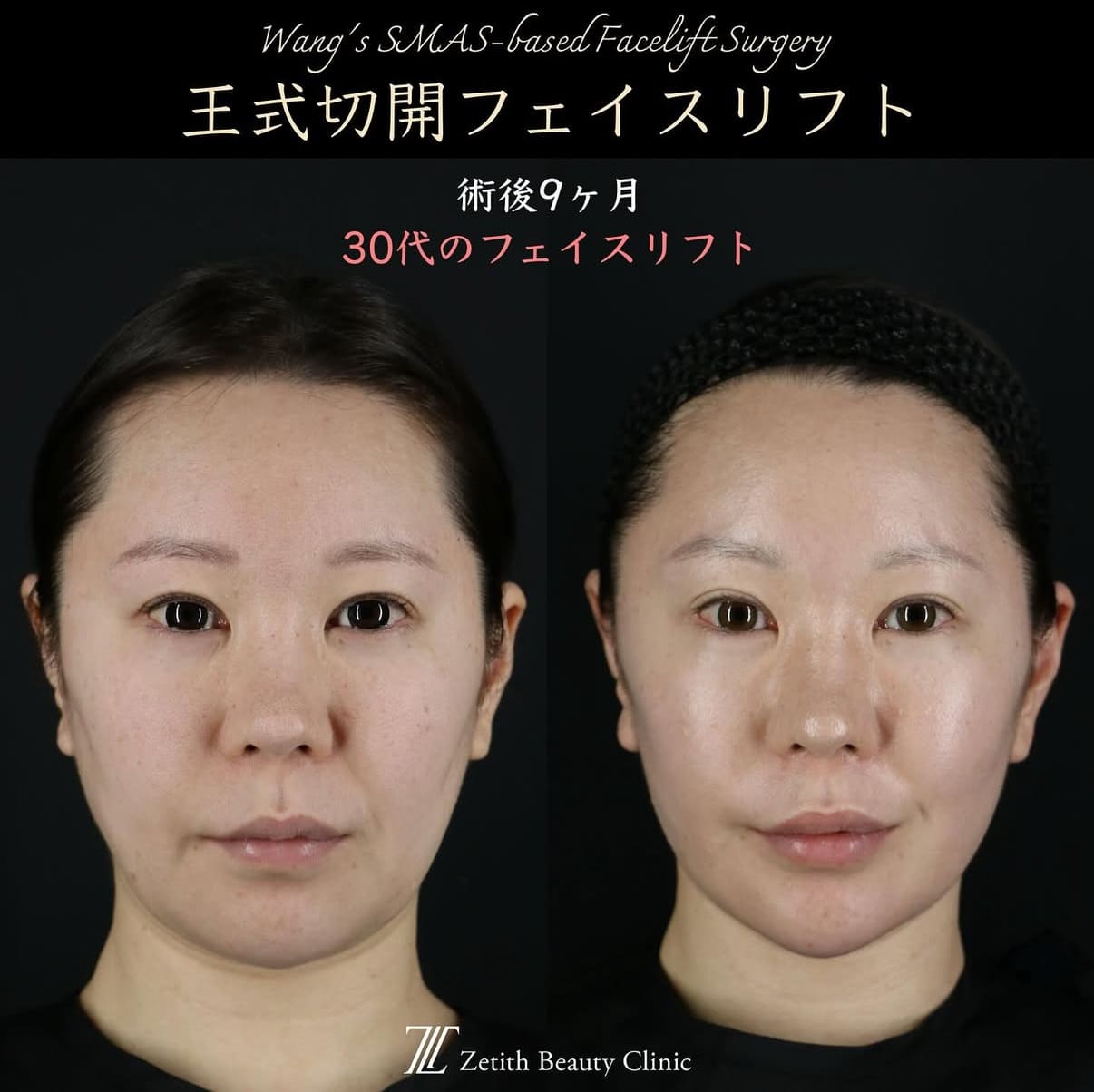 王医師による切開リフトの術前/術後9ヶ月