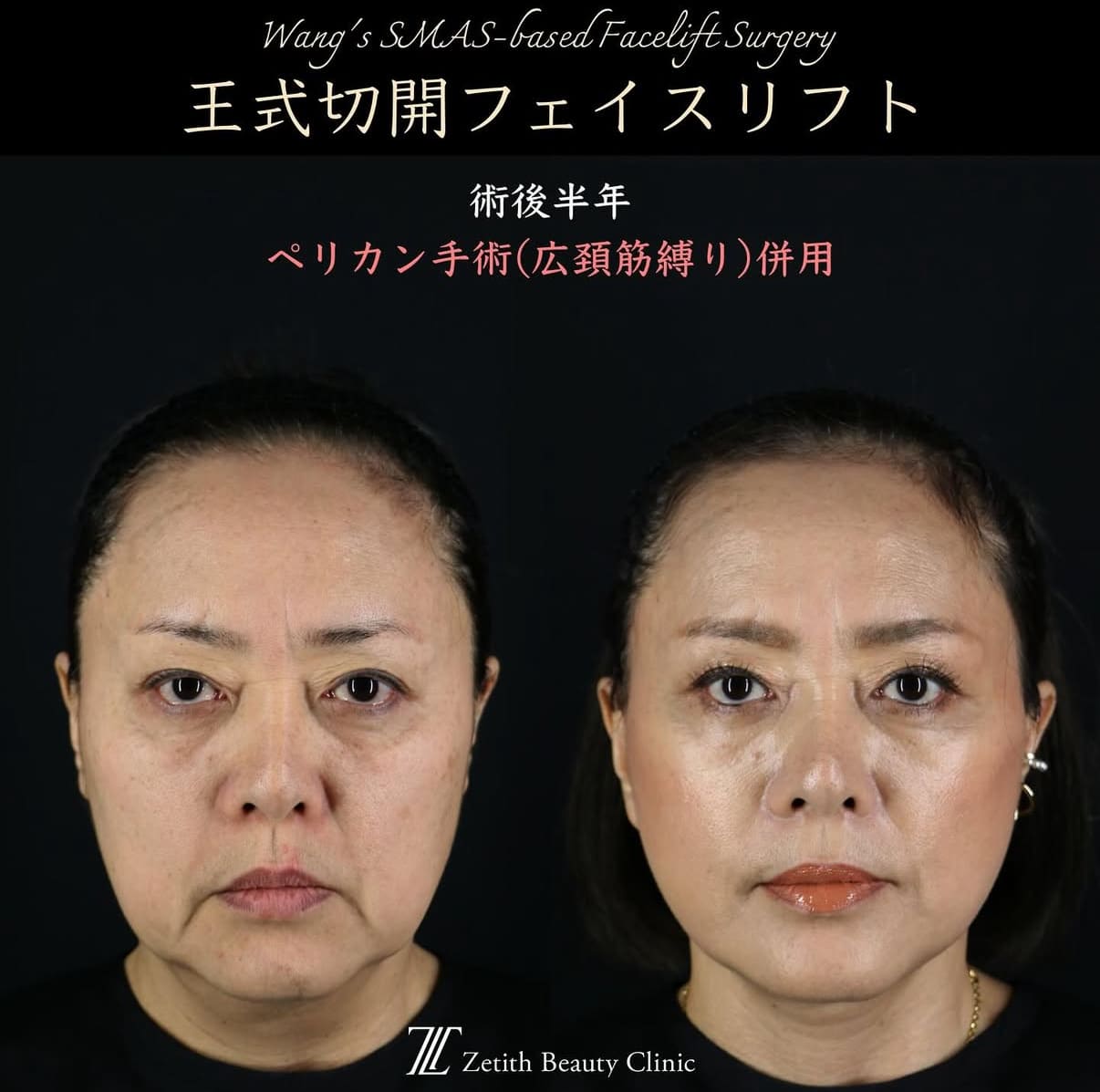 王医師による切開リフトの術前/術後6ヶ月