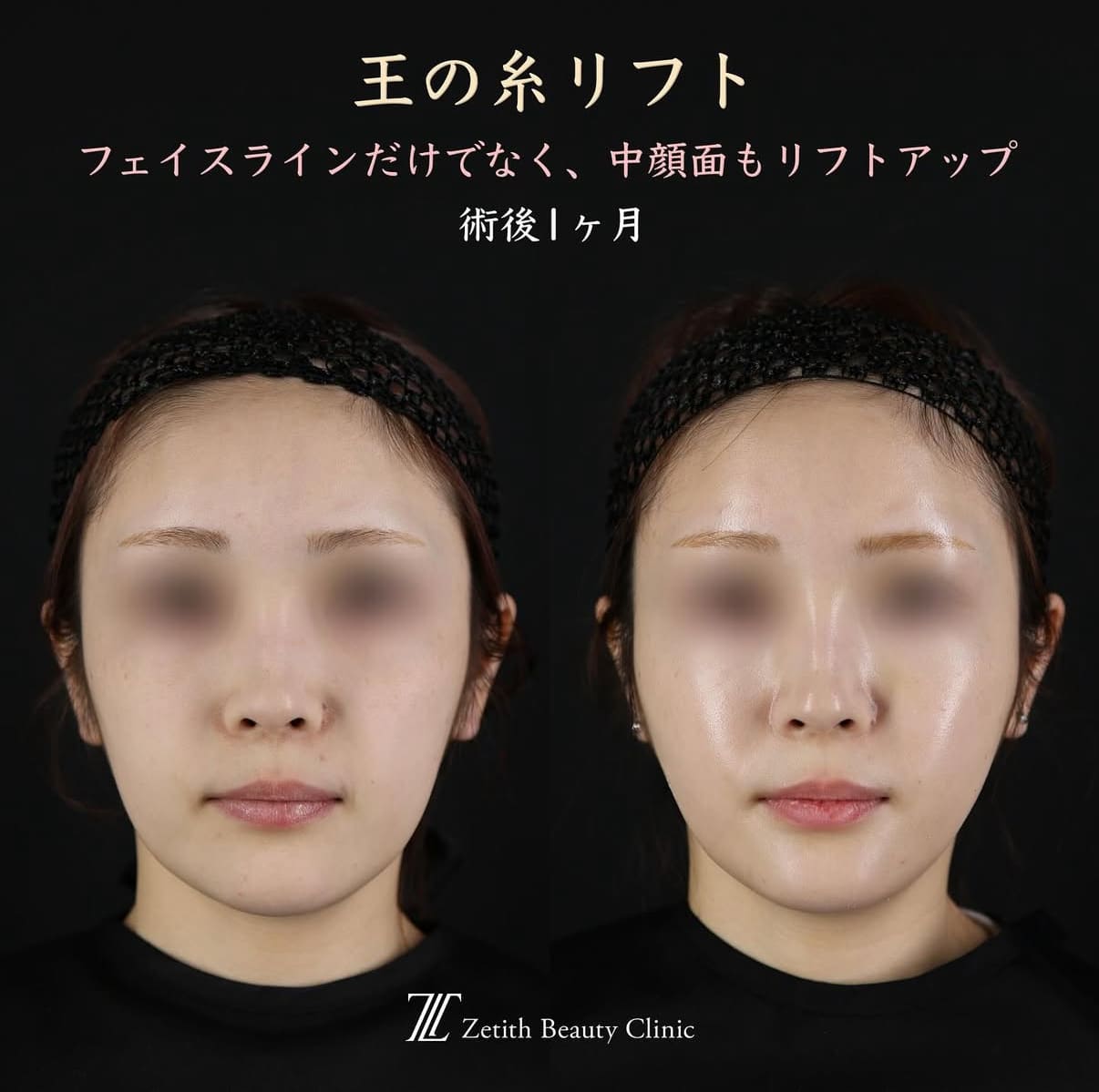 王医師による糸リフトの術前/術後1ヶ月