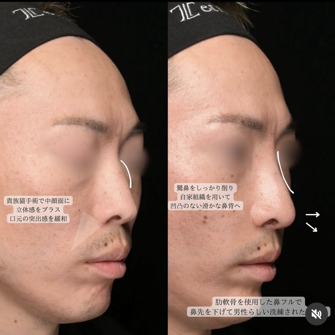 守屋医師による鼻整形の術前/術後 术后 