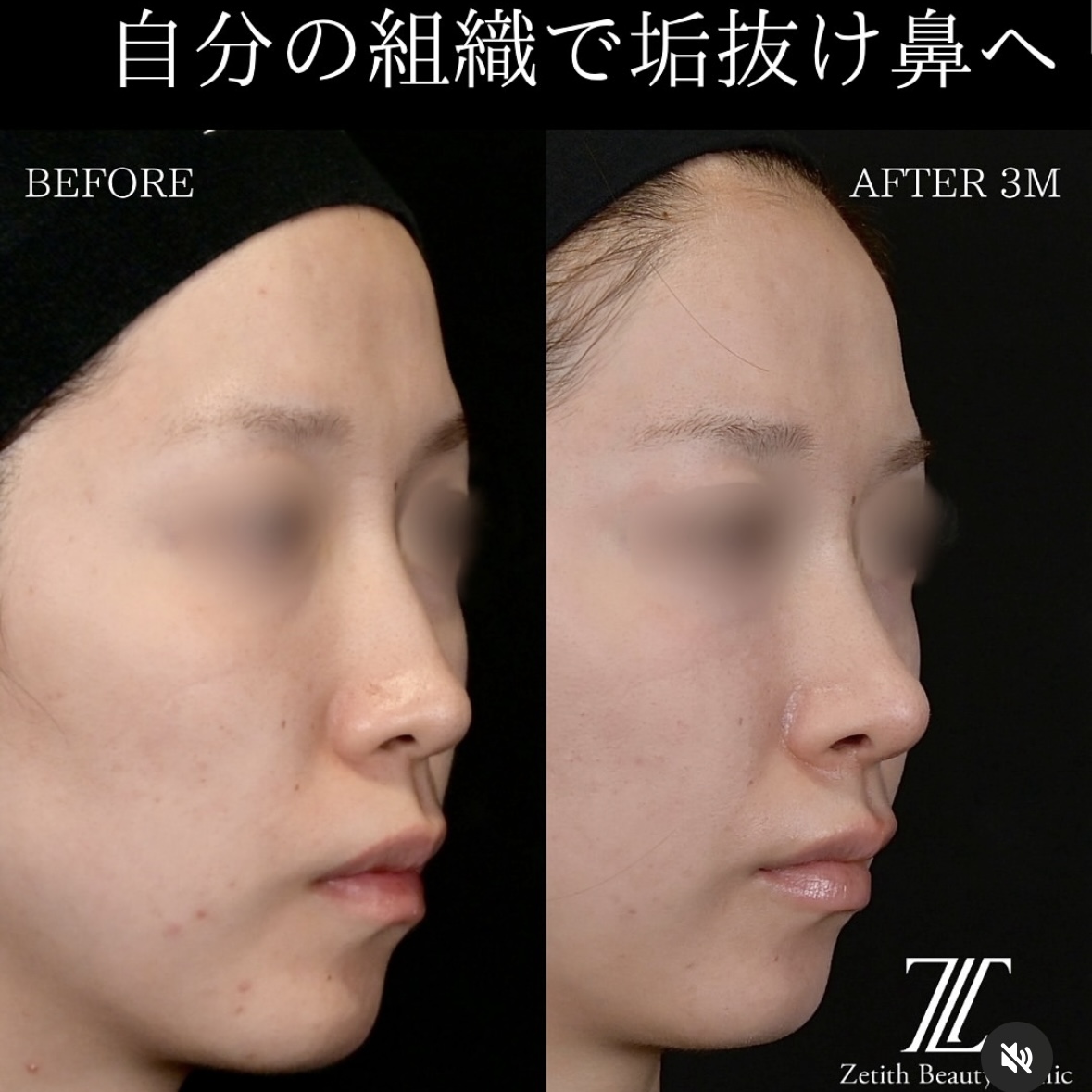 守屋医師による鼻整形の術前/術後