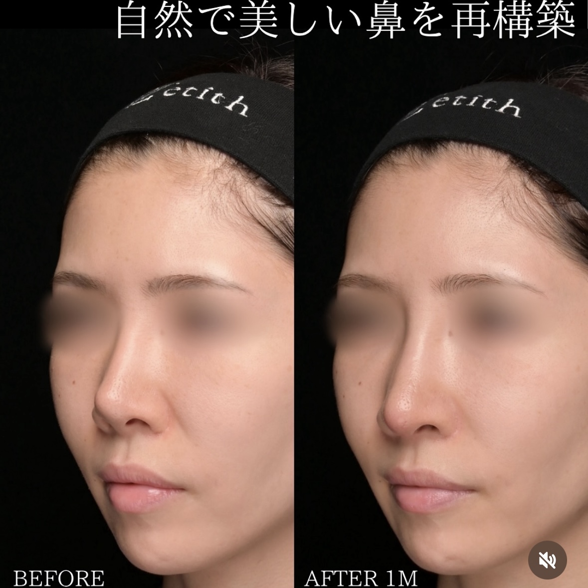 守屋医師による鼻整形の術前/術後