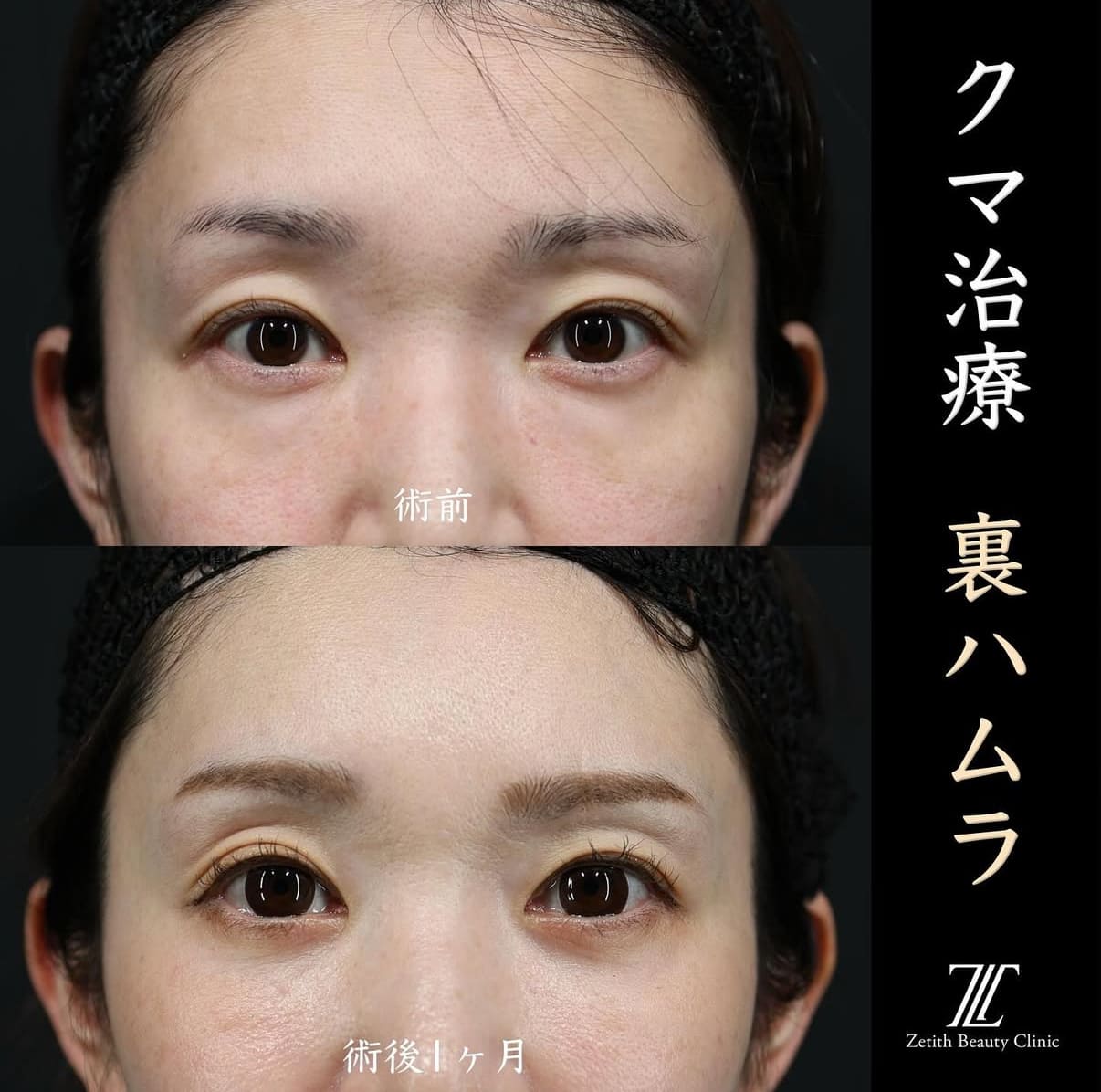 王医師によるクマ治療の術前/術後1ヶ月