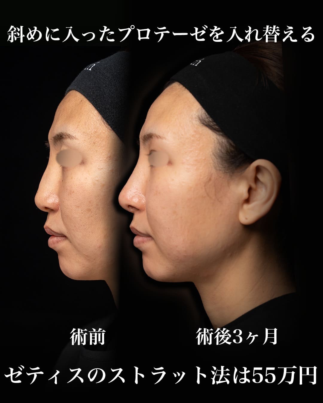 中村医師による鼻整形の術前/術後３ヶ月 施術後 