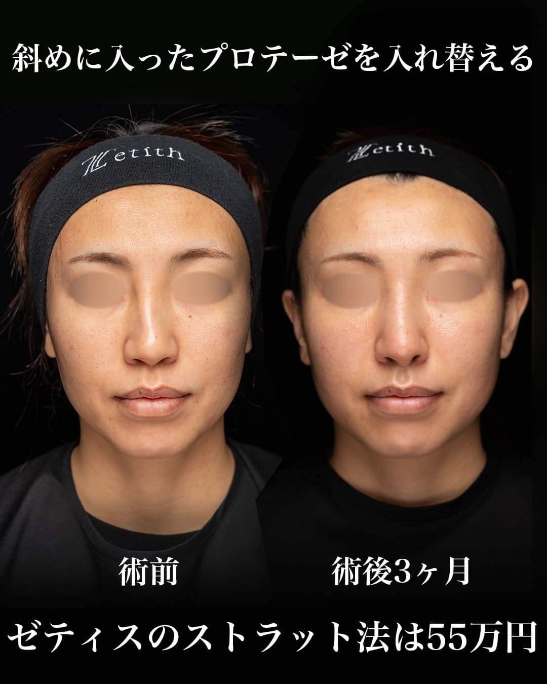 中村医師による鼻整形の術前/術後３ヶ月