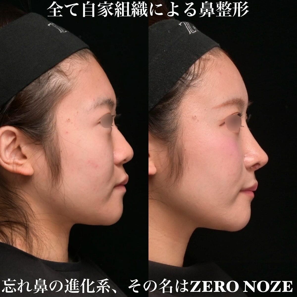 鉄医師による鼻整形の術前/術後３ヶ月 施術後 