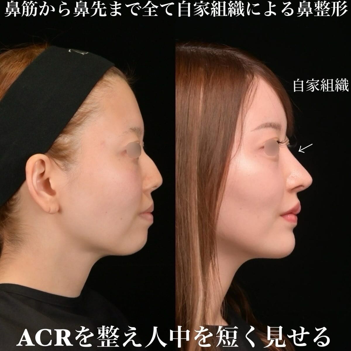 鉄医師による鼻整形の術前/術後6ヶ月 施術後 