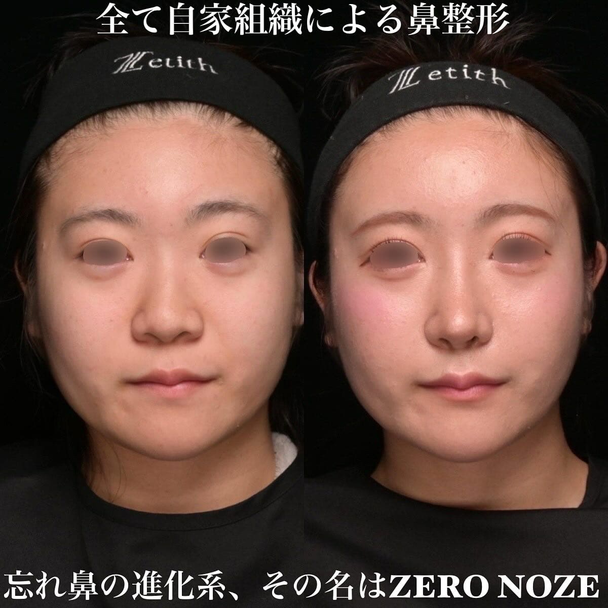 鉄医師による鼻整形の術前/術後３ヶ月