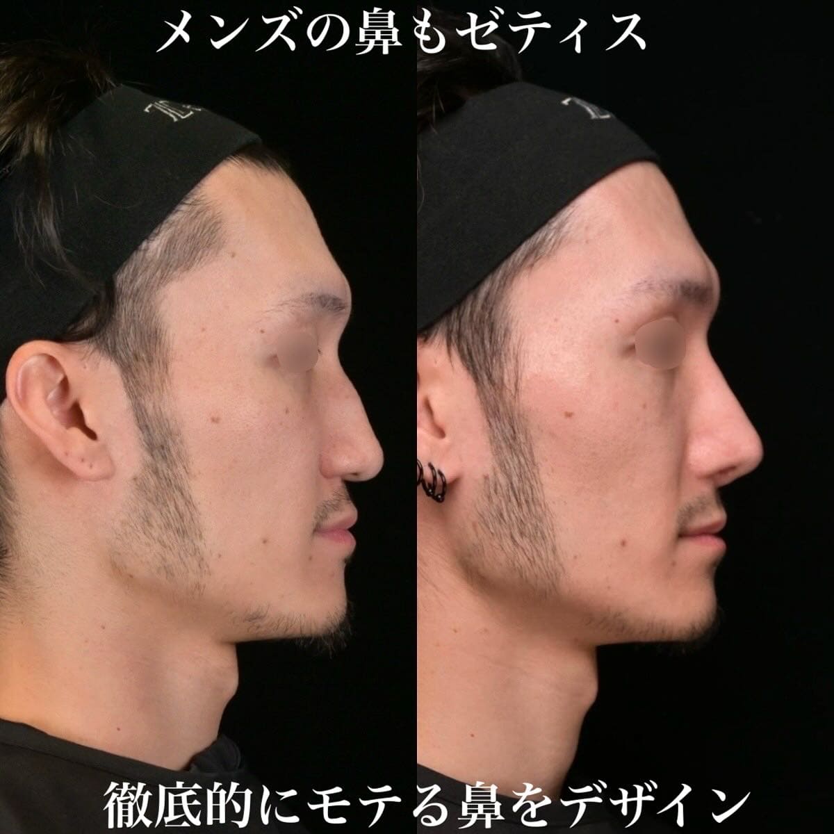 鉄医師による鼻整形の術前/術後6ヶ月 施術後 