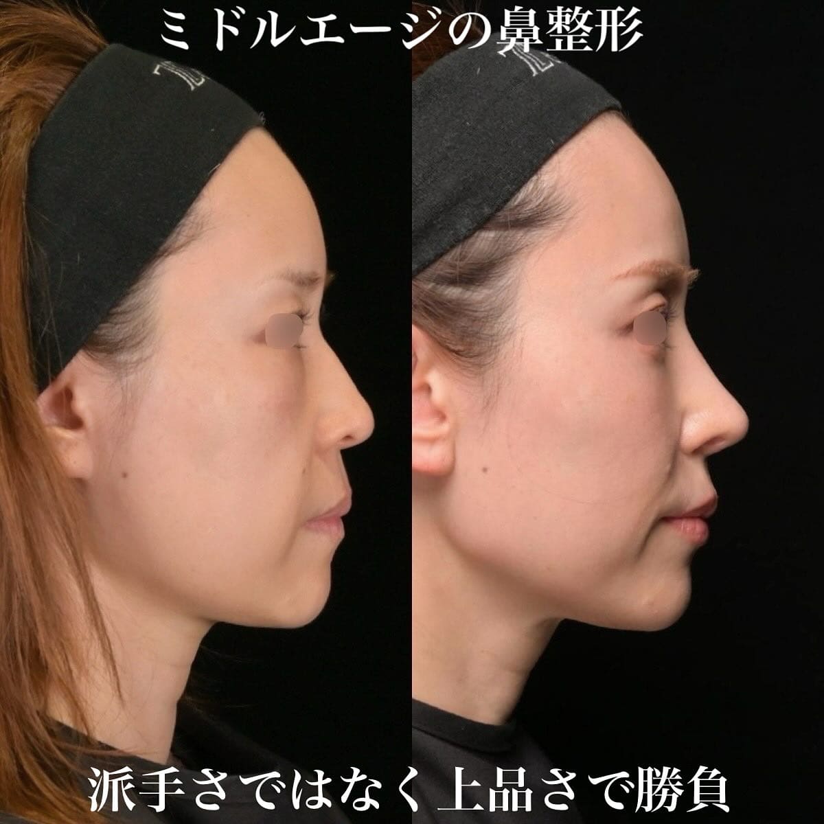 鉄医師による鼻整形の術前/術後6ヶ月 术后 