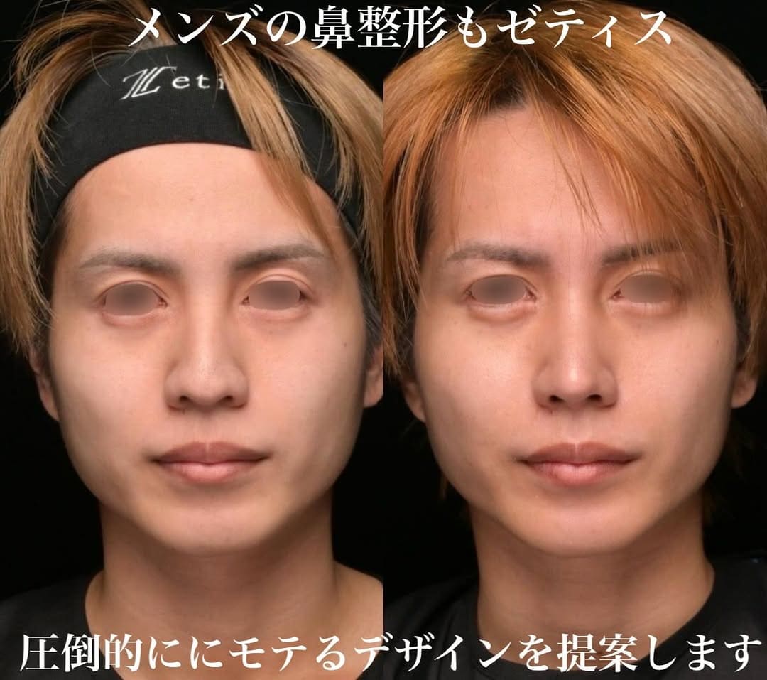 鉄医師による鼻整形の術前/術後３ヶ月