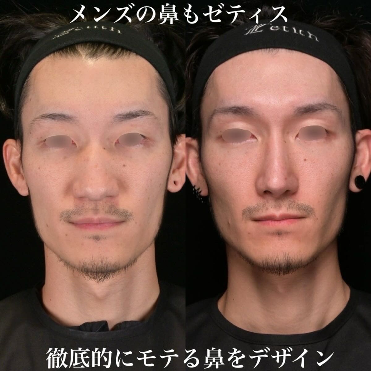 鉄医師による鼻整形の術前/術後6ヶ月