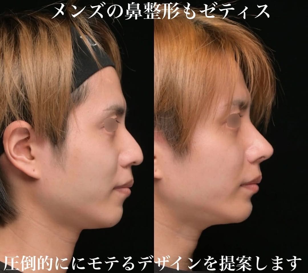 鉄医師による鼻整形の術前/術後３ヶ月 施術後 