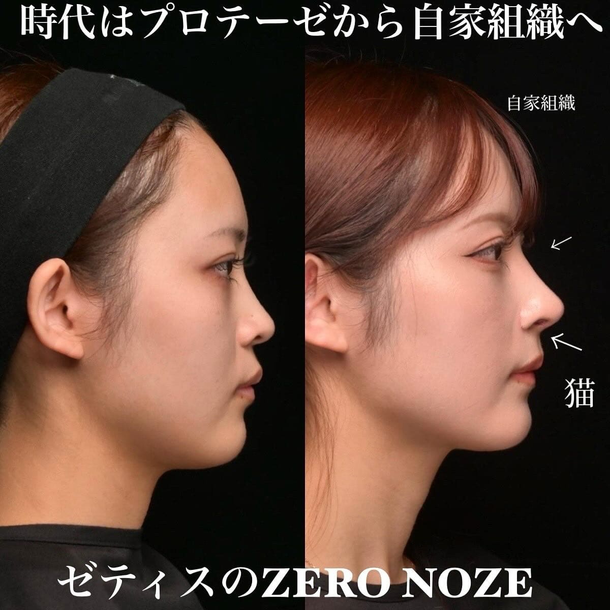 鉄医師による鼻整形の術前/術後1ヶ月 Дараа 
