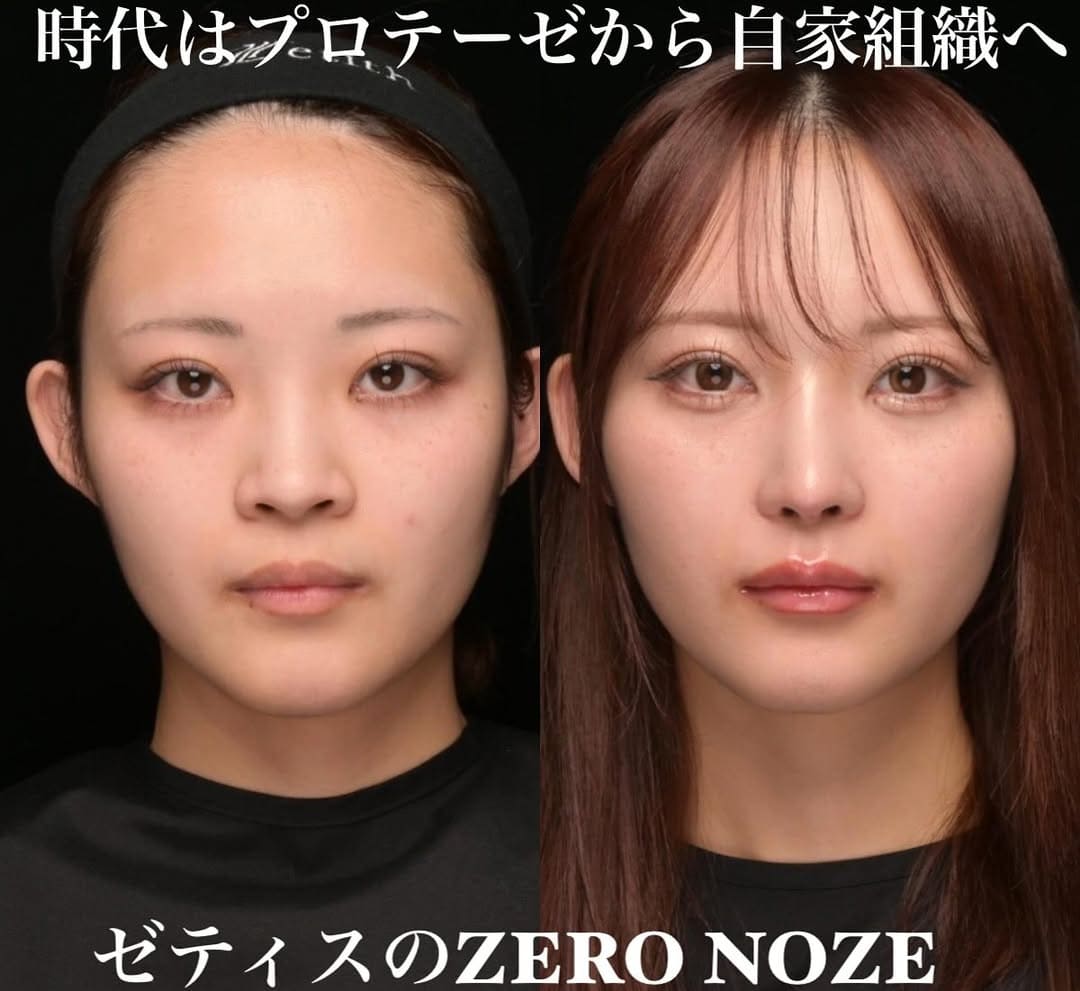 鉄医師による鼻整形の術前/術後1ヶ月