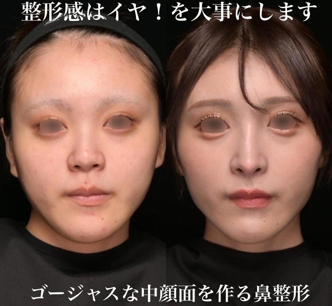 鉄医師による鼻整形の術前/術後３ヶ月